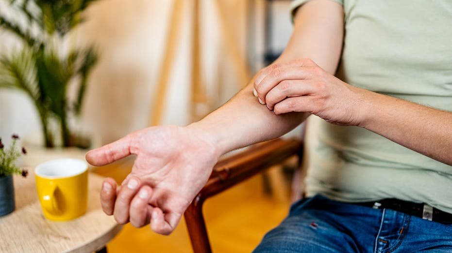 Scratching a mosquito bite worsens inflammation but may offer a bacterial defense, study finds